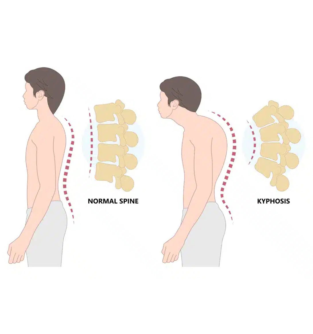 Kyphosis Correction Surgeon in Delhi