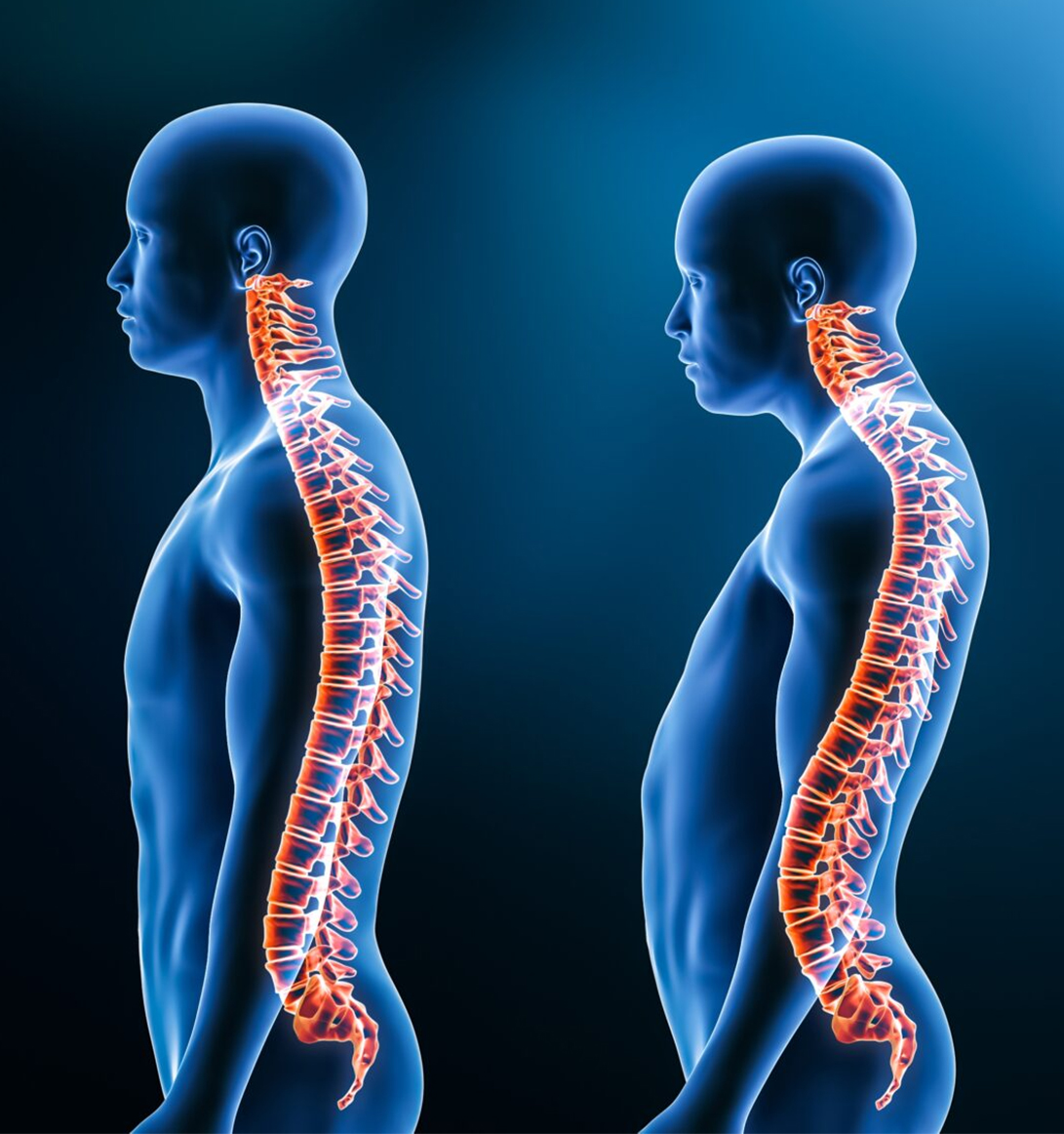 Kyphosis Correction Surgeon in Delhi