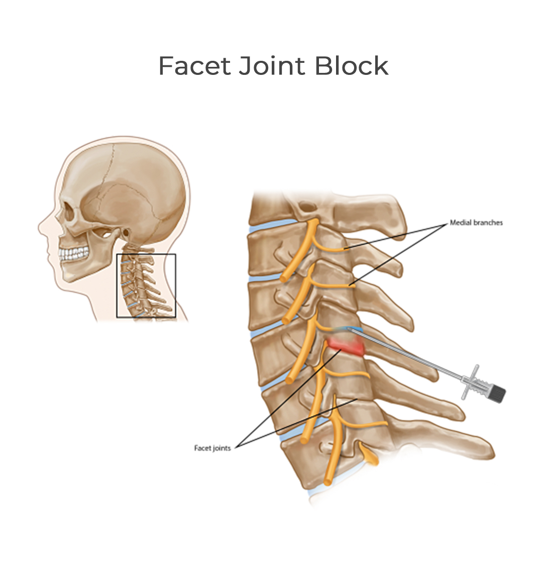 facet-joint-block