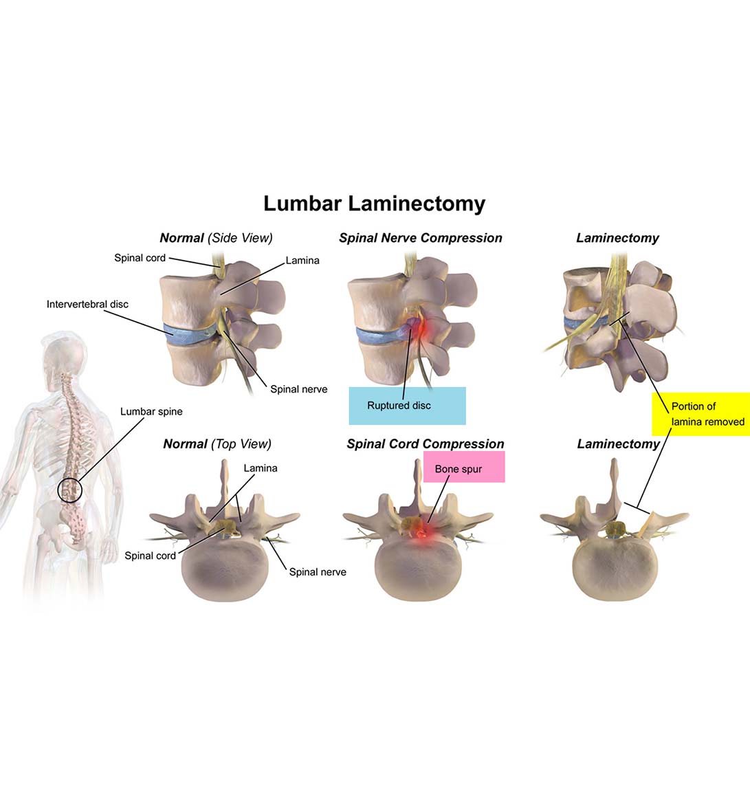 Slip Disc Surgery in Delhi