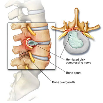 facet-joint-block