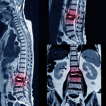 Kyphosis Correction Surgeon in Delhi