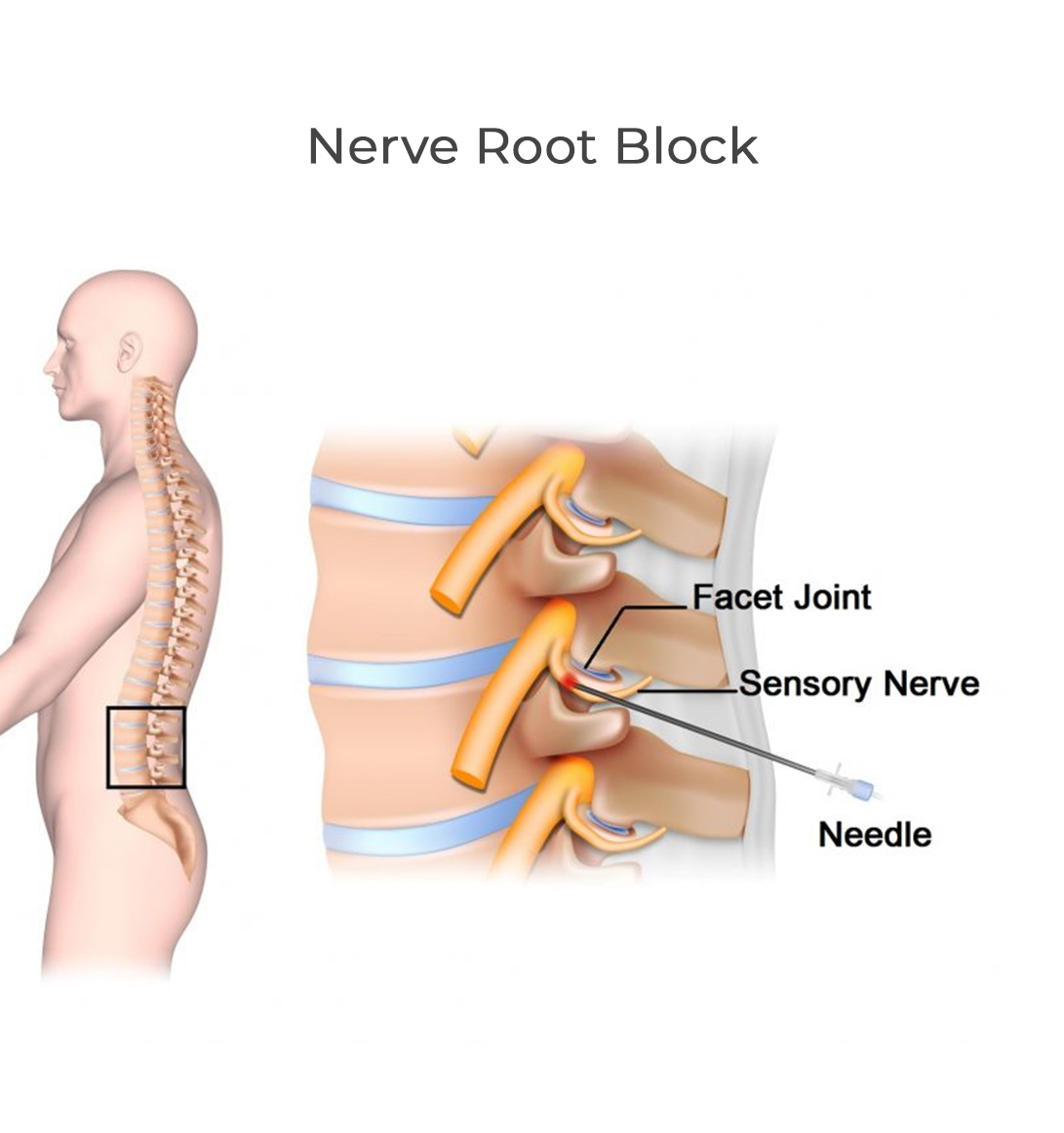 Kyphosis Correction Surgeon in Delhi