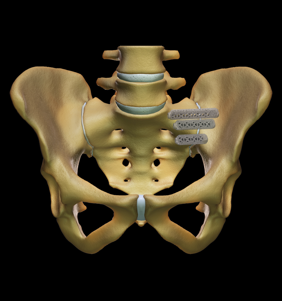 Kyphosis Correction Surgeon in Delhi