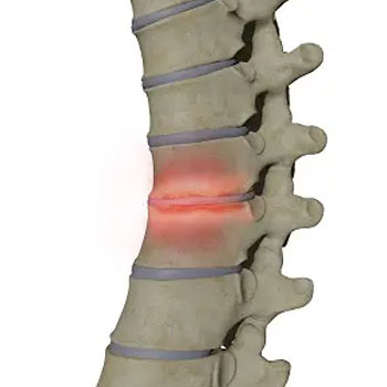 facet-joint-block